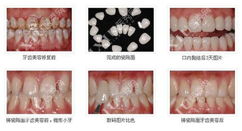 牙齿贴面美白过程示意图