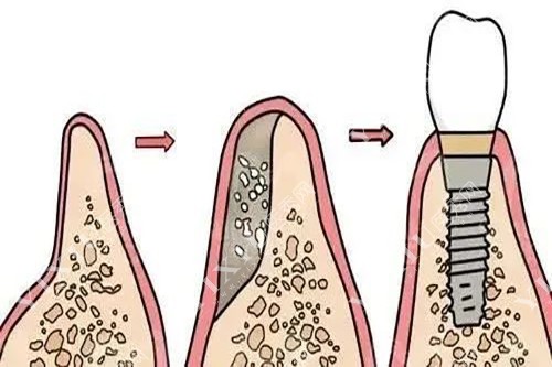 骨粉种植牙过程示意图