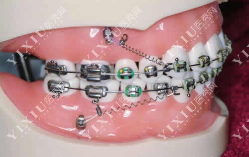 牙齿矫正模型图