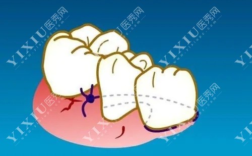 牙齿炎症卡通图
