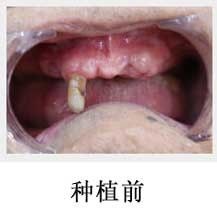 广州广大口腔医院即刻用种植牙真人对比实例公开_广州广大口腔医院整形案例