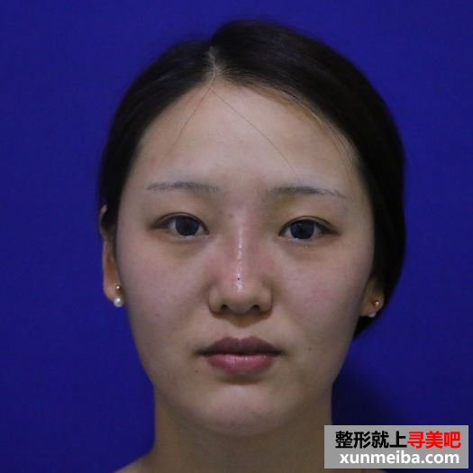 颜值不够,玻尿酸隆鼻来凑 颜值不够,玻尿酸隆鼻来凑