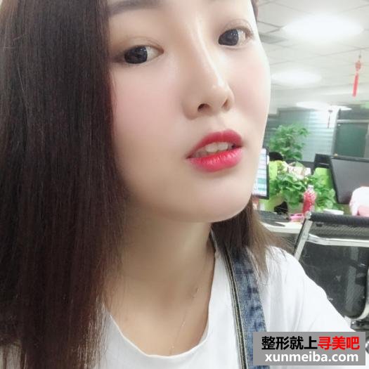 颜值不够,玻尿酸隆鼻来凑 颜值不够,玻尿酸隆鼻来凑