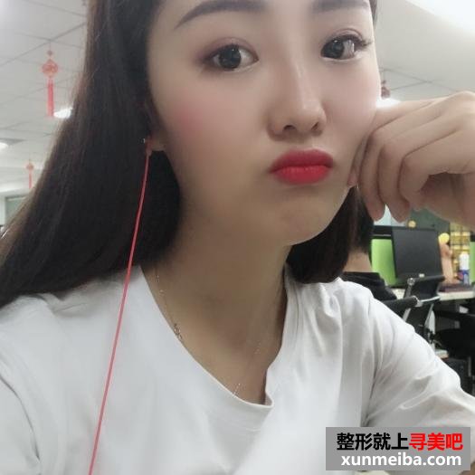 颜值不够,玻尿酸隆鼻来凑 颜值不够,玻尿酸隆鼻来凑