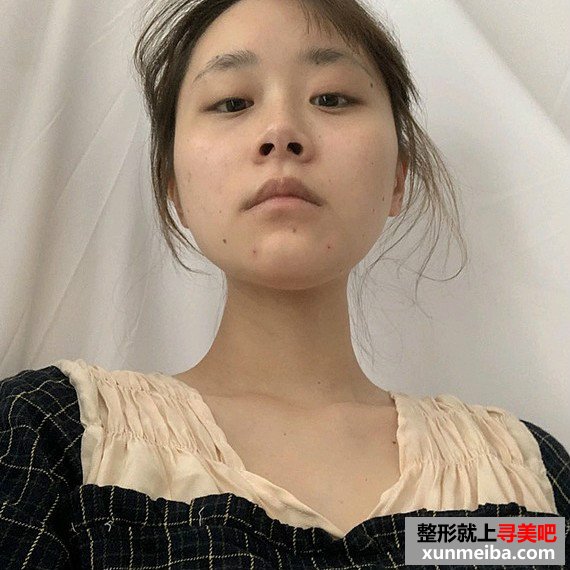做一次玻尿酸垫下巴,魅力无穷 做一次玻尿酸垫下巴,魅力无穷