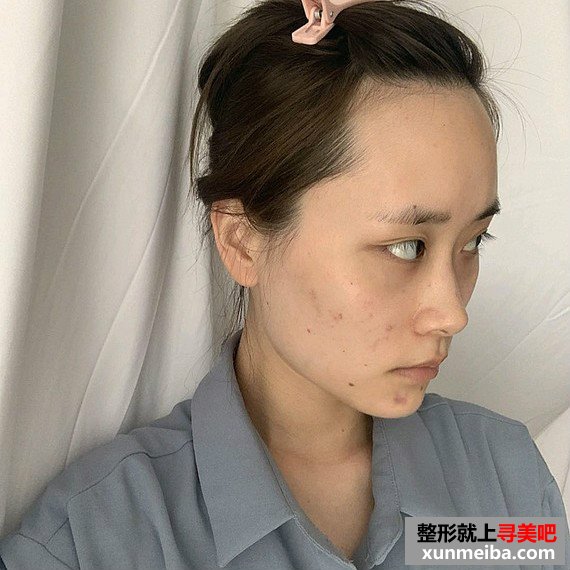 做玻尿酸垫下巴 做玻尿酸垫下巴